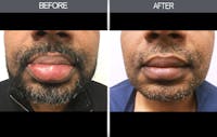 Lip Reduction Before & After Gallery - Patient 4455031 - Image 1