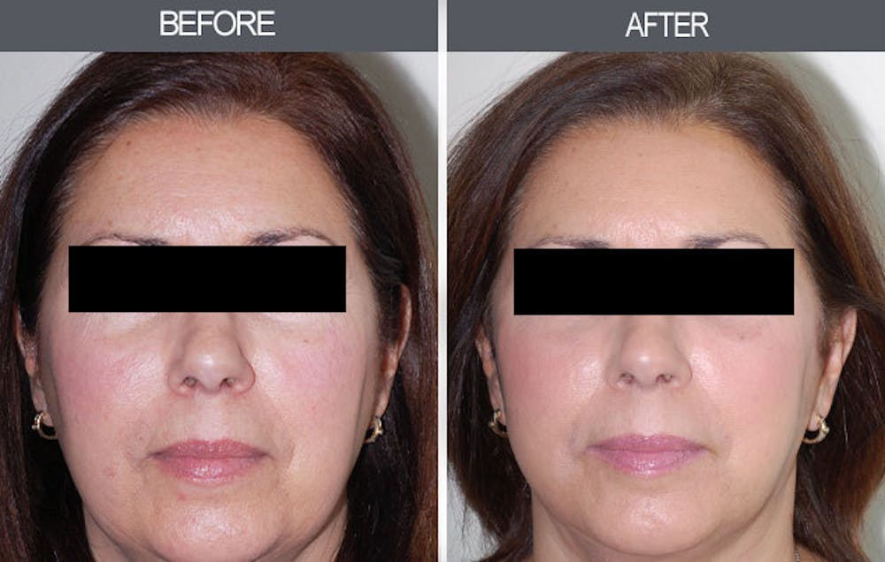 Facial Fat Transfer Gallery Before & After Gallery - Patient 4455181 - Image 1