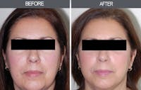 Facial Fat Transfer Gallery Before & After Gallery - Patient 4455181 - Image 1