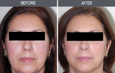 Facial Fat Transfer Before & After Gallery - Patient 4455181 - Image 1