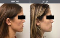 Chin Reduction Before & After Gallery - Patient 4455276 - Image 1