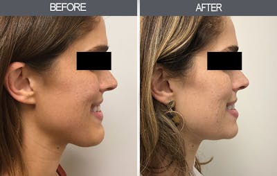 Chin Reduction Gallery Before & After Gallery - Patient 4455276 - Image 1