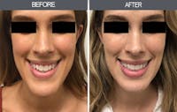 Chin Reduction Gallery Before & After Gallery - Patient 328548 - Image 1
