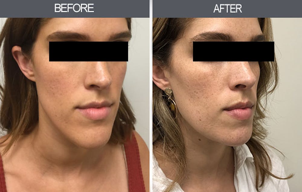 Chin Reduction Before & After Gallery - Patient 4455276 - Image 4
