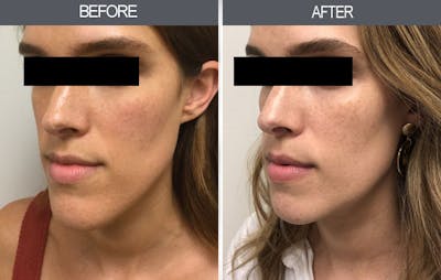 Chin Reduction Gallery Before & After Gallery - Patient 720958 - Image 1