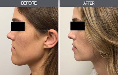 Chin Reduction Before & After Gallery - Patient 4455276 - Image 6