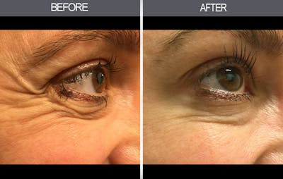 BOTOX Gallery Before & After Gallery - Patient 149147470 - Image 1