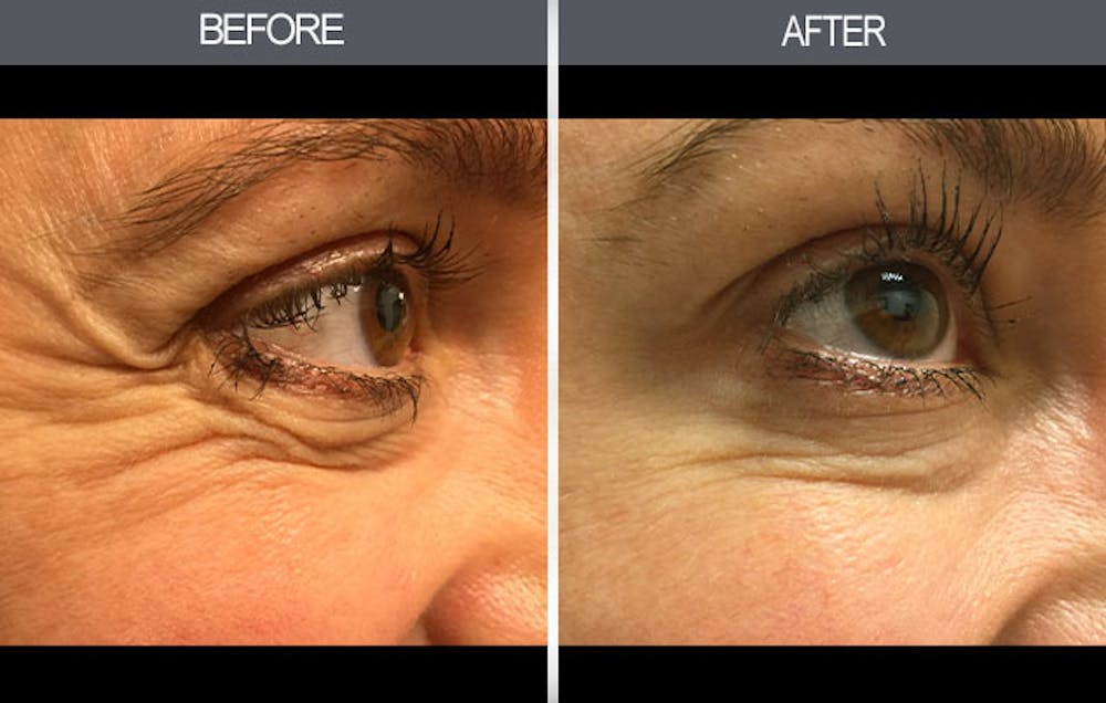 BOTOX Before & After Gallery - Patient 149147470 - Image 1