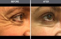 BOTOX Gallery Before & After Gallery - Patient 149147470 - Image 1