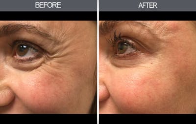 Fillers Before & After Gallery - Patient 4455483 - Image 2