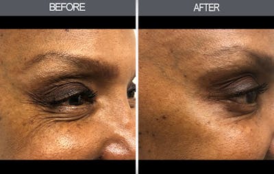BOTOX Before & After Gallery - Patient 149147469 - Image 1
