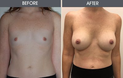 Breast Augmentation Gallery Before & After Gallery - Patient 5890663 - Image 1