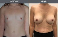 Breast Augmentation Before & After Gallery - Patient 5890663 - Image 1