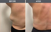 Lipoma Removal Before & After Gallery - Patient 5890666 - Image 1