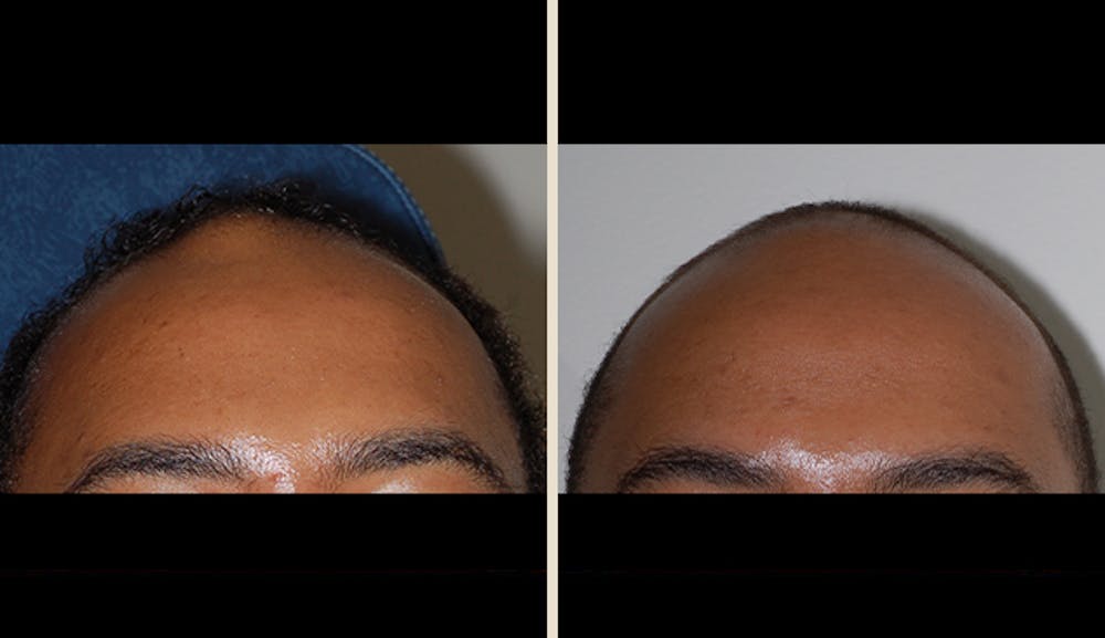Lipoma Removal Gallery Before & After Gallery - Patient 5890667 - Image 1