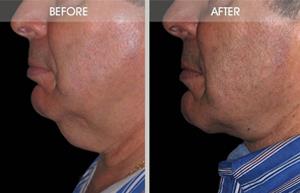 Neck Lift Before and After Photo