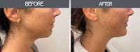 Chin Implants Before & After Gallery - Patient 7594791 - Image 1