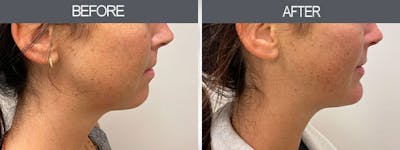 Chin Implants Before & After Gallery - Patient 7594791 - Image 1