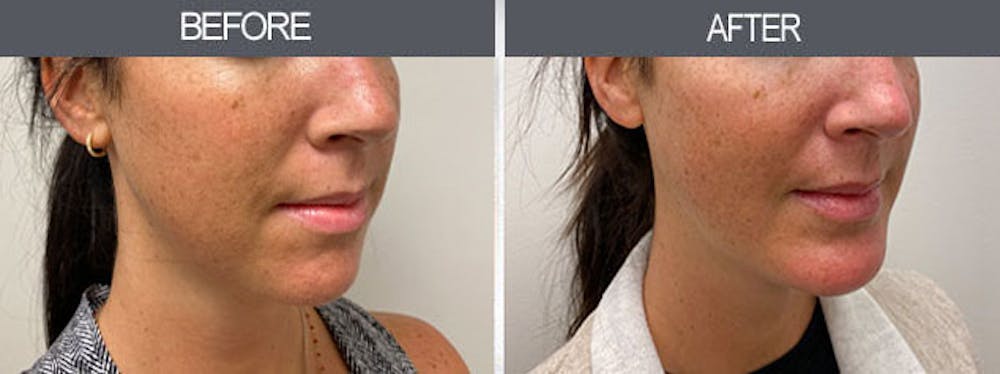 Chin Implants Gallery Before & After Gallery - Patient 7594791 - Image 2