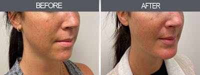 Chin Implants Gallery Before & After Gallery - Patient 7594791 - Image 2