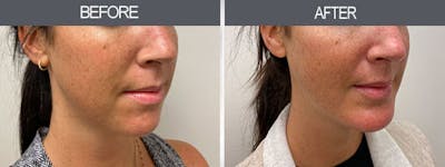 Chin Implants Gallery Before & After Gallery - Patient 7594791 - Image 2