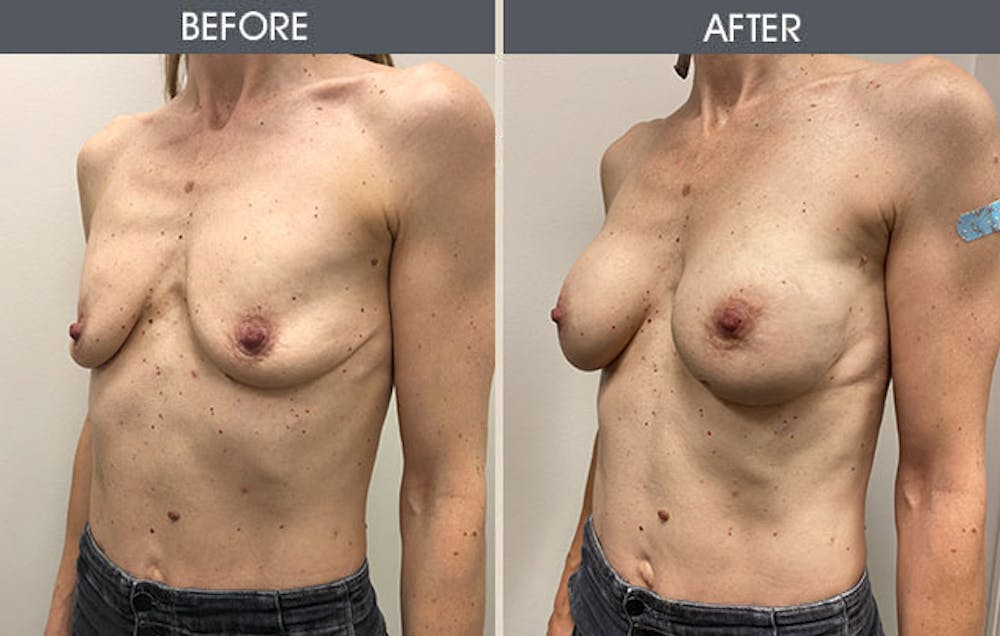 Breast Augmentation Gallery Before & After Gallery - Patient 8285474 - Image 2