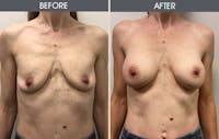 Breast Augmentation Before & After Gallery - Patient 8285474 - Image 1