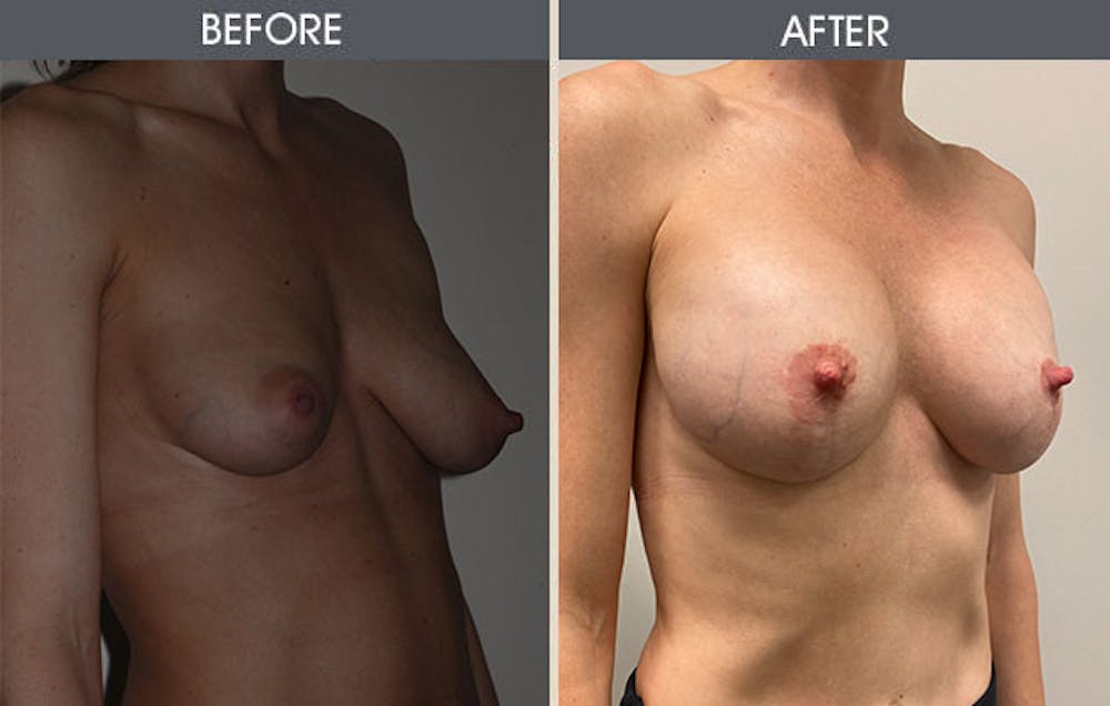 Breast Augmentation Before & After Gallery - Patient 8285486 - Image 2