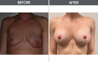 Breast Augmentation Before & After Gallery - Patient 8285486 - Image 1