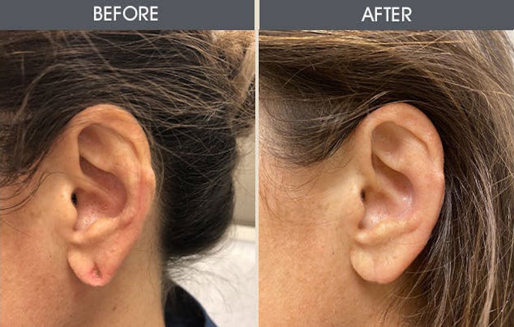 Earlobe Repair Gallery Before & After Gallery - Patient 5890665 - Image 1