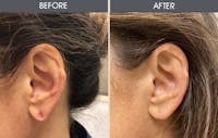 Earlobe Repair Gallery Before & After Gallery - Patient 5890665 - Image 1