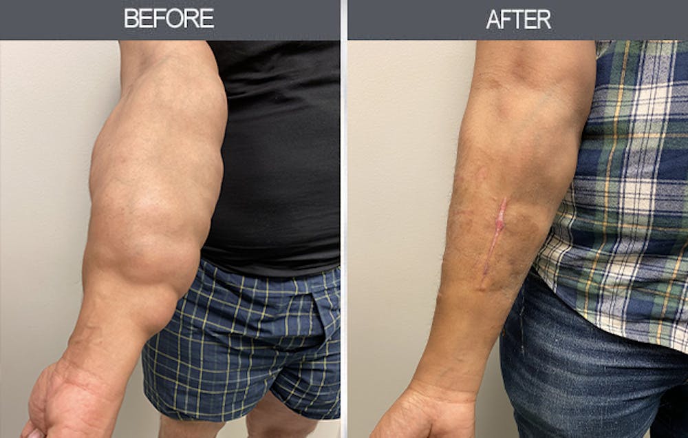 Lipoma Removal Gallery Before & After Gallery - Patient 11260028 - Image 1
