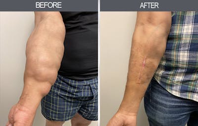 Lipoma Removal Gallery Before & After Gallery - Patient 11260028 - Image 1