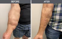Lipoma Removal Before & After Gallery - Patient 11260028 - Image 1