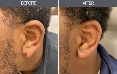 Earlobe Repair Gallery Before & After Gallery - Patient 11260031 - Image 1