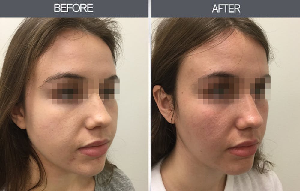 Buccal Fat Removal Before & After Gallery - Patient 11260040 - Image 1