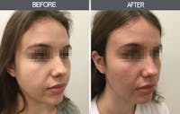 Buccal Fat Removal Gallery Before & After Gallery - Patient 11260040 - Image 1