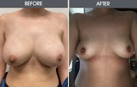 Breast Implant Removal Gallery Before & After Gallery - Patient 5890664 - Image 1