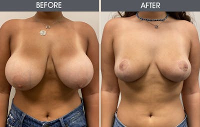 Breast Reduction Before & After Gallery - Patient 12607034 - Image 1