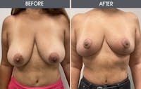 Breast Reduction Before & After Gallery - Patient 14391049 - Image 1