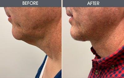 Neck Lift Before & After Gallery - Patient 14391052 - Image 1