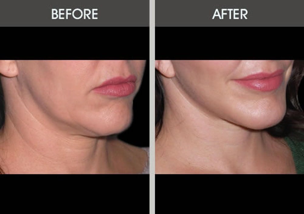Chin Implants Gallery Before & After Gallery - Patient 2206834 - Image 2