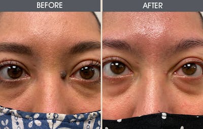 Mole Removal Before & After Gallery - Patient 19339443 - Image 2