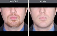 Submental Liposuction Gallery Before & After Gallery - Patient 22112243 - Image 1