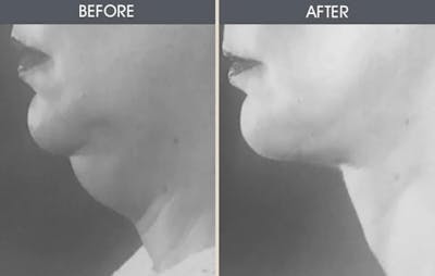 Facelift and Mini Facelift Gallery Before & After Gallery - Patient 22112623 - Image 1