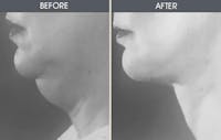 Facelift and Mini Facelift Before & After Gallery - Patient 22112623 - Image 1