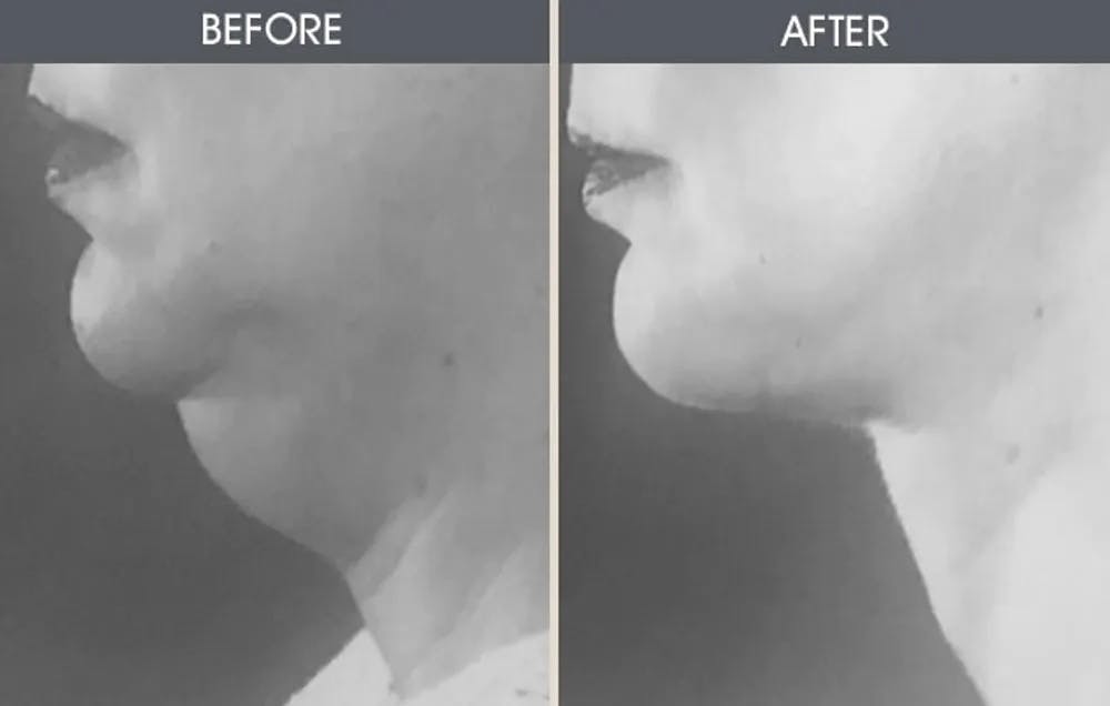 Submental Liposuction Gallery Before & After Gallery - Patient 22112625 - Image 1