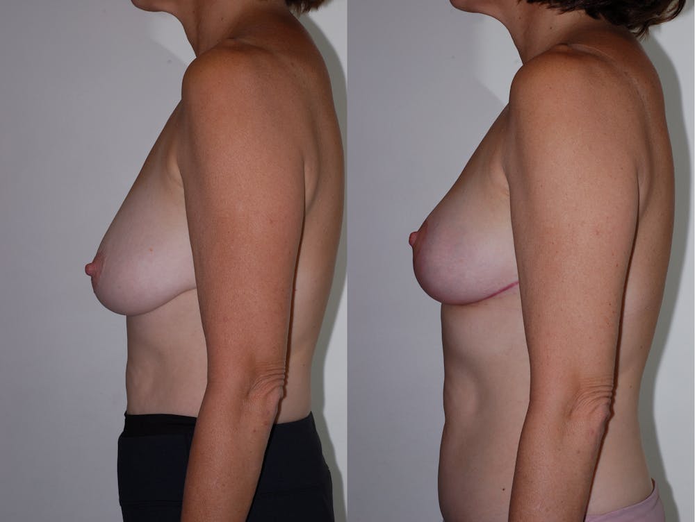 Breast Lift Gallery Before & After Gallery - Patient 2207169 - Image 2