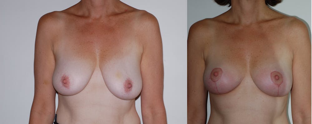 Breast Lift Gallery Before & After Gallery - Patient 2207169 - Image 3