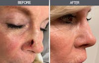 Skin Cancer Reconstruction Before & After Gallery - Patient 22935158 - Image 1
